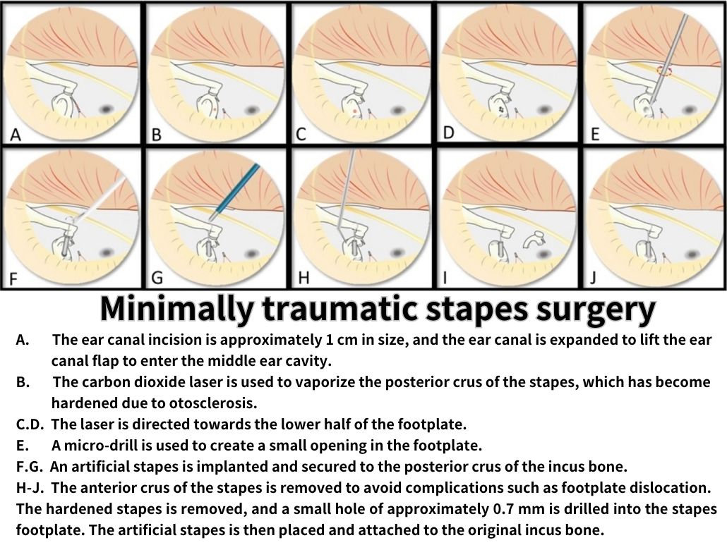 Text - Stapes Surgery